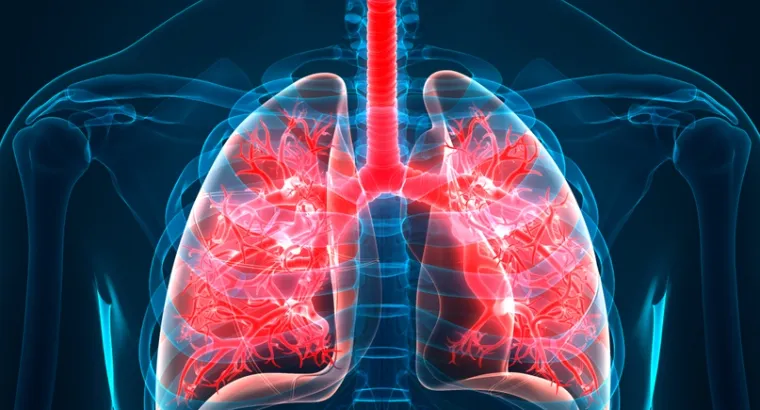 Idiopathic Pulmonary Fibrosis